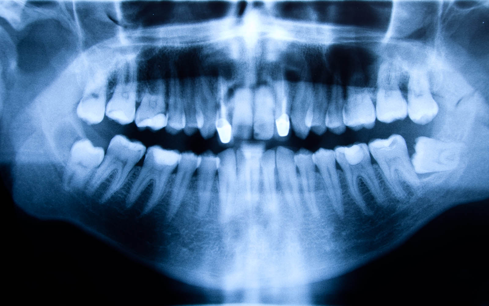 Dental X Ray