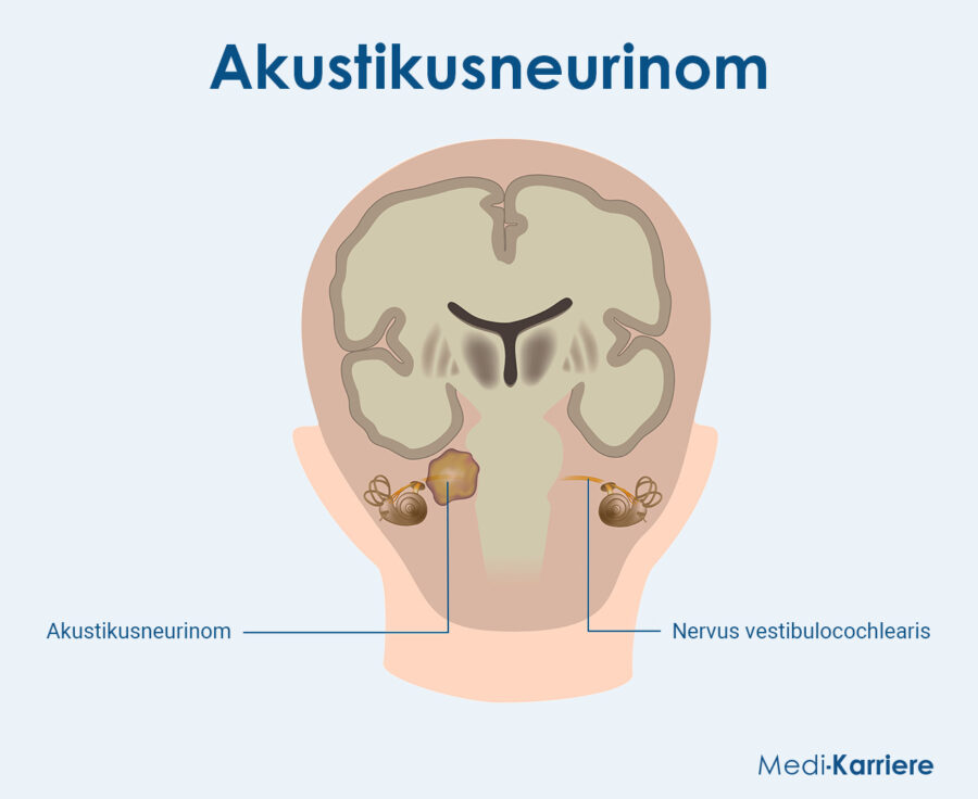 Grafik Kleinhirnbrückenwinkel