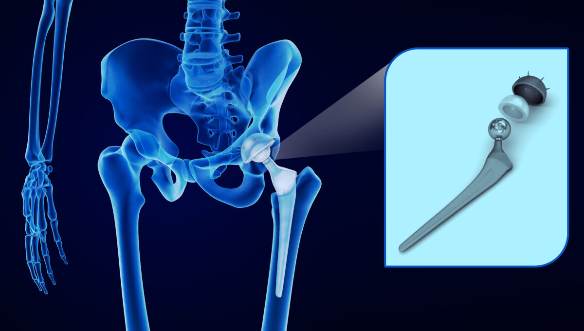 Hip,Replacement,Implant,Installed,In,The,Pelvis,Bone.,X Ray,View.