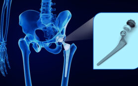 Hip,Replacement,Implant,Installed,In,The,Pelvis,Bone.,X Ray,View.