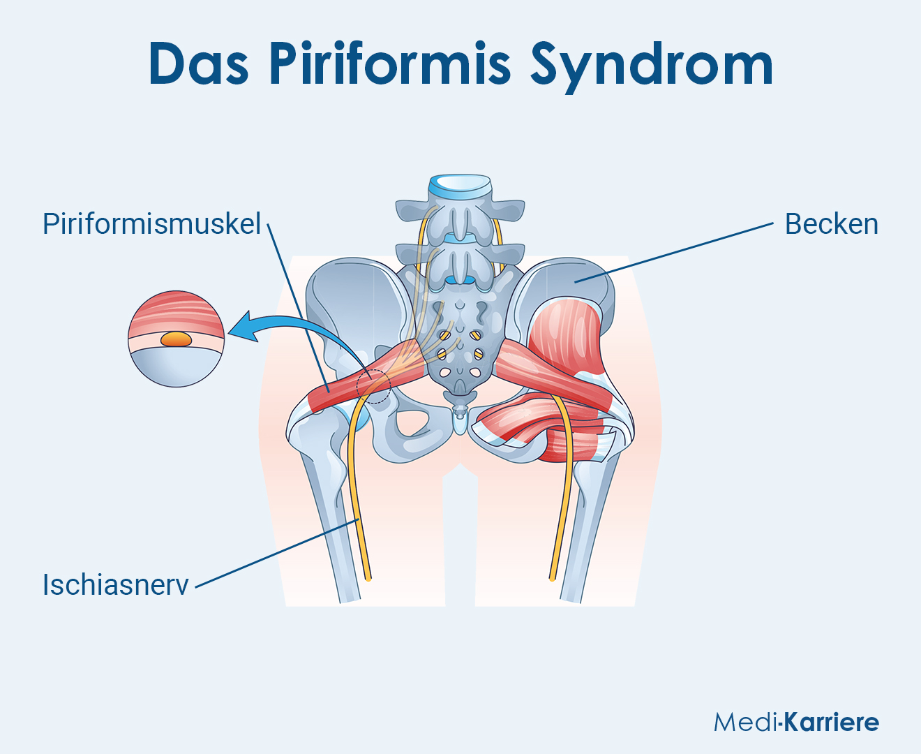 Piriformis Syndrom Grafik