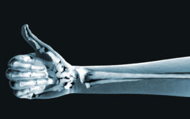 X Ray,Hand,On,Black,Background