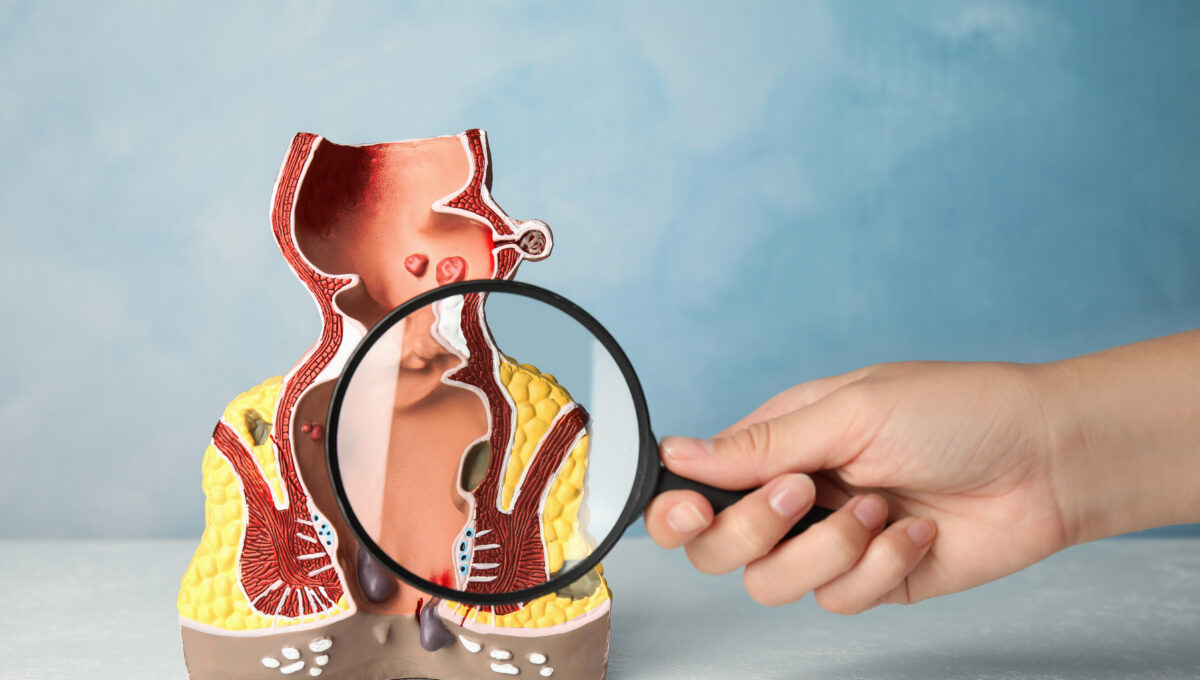 Doctor,With,Magnifying,Glass,Showing,Model,Of,Unhealthy,Lower,Rectum