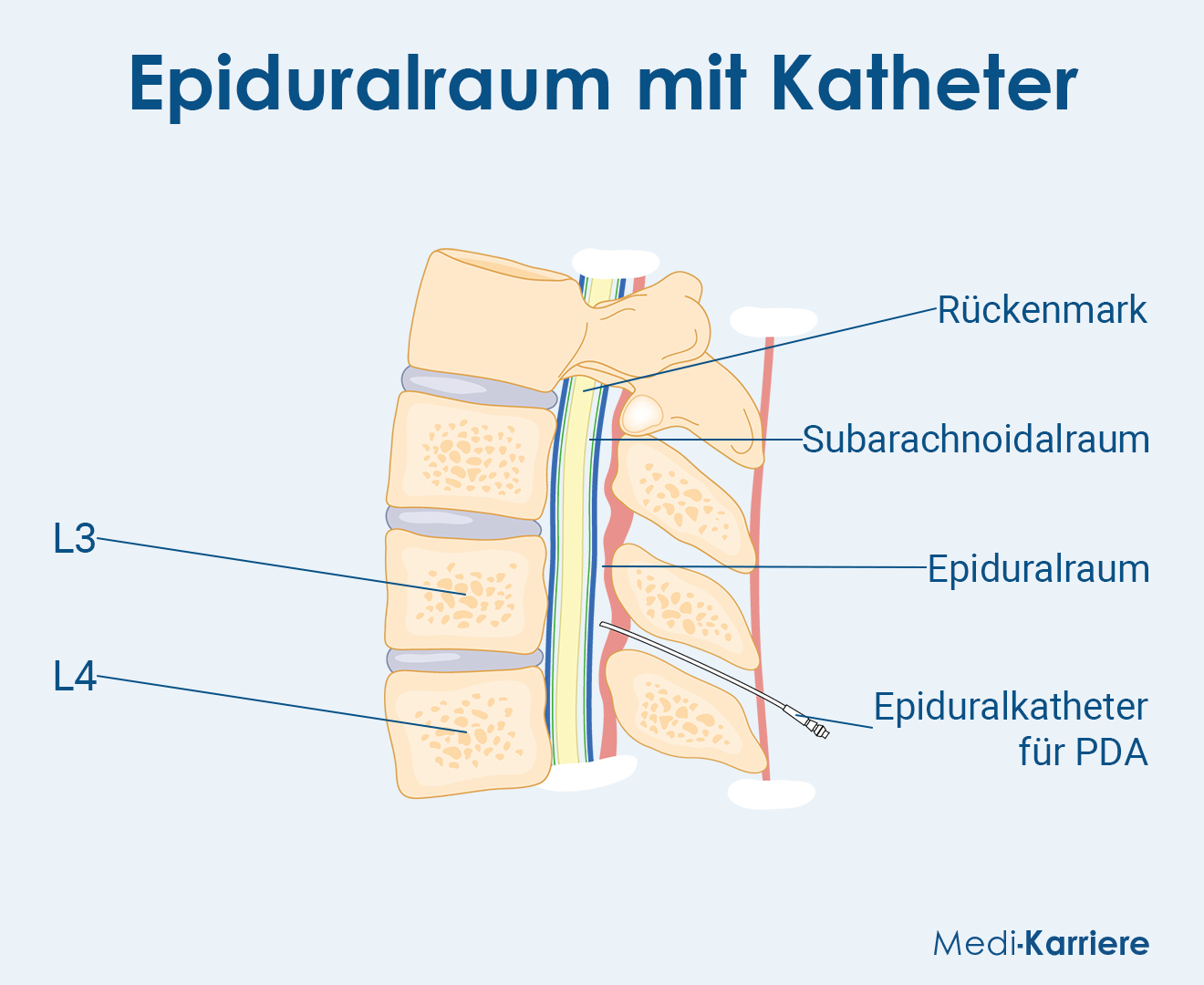 Epiduralraum