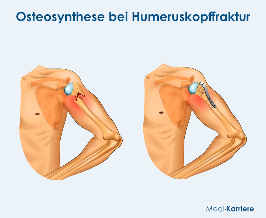 Grafik Humeruskopf