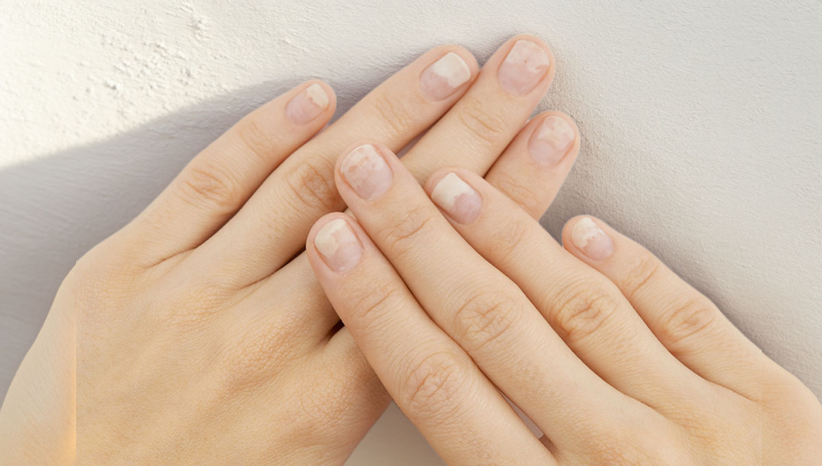 Fingernails,With,Onycholysis,After,Removing,Gel,Polish,On,Grey,Background.