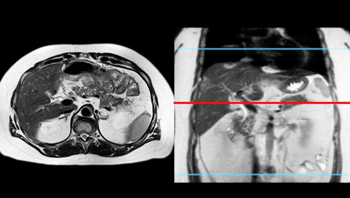 Mri,Of,The,Upper,Abdomen,Is,A,Non Invasive,Imaging,Technique