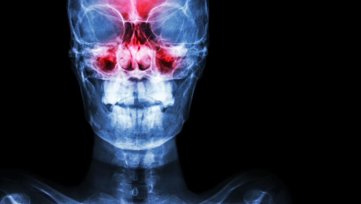 Sinusitis.,Film,X Ray,Skull,Ap,(,Anterior, ,Posterior,)