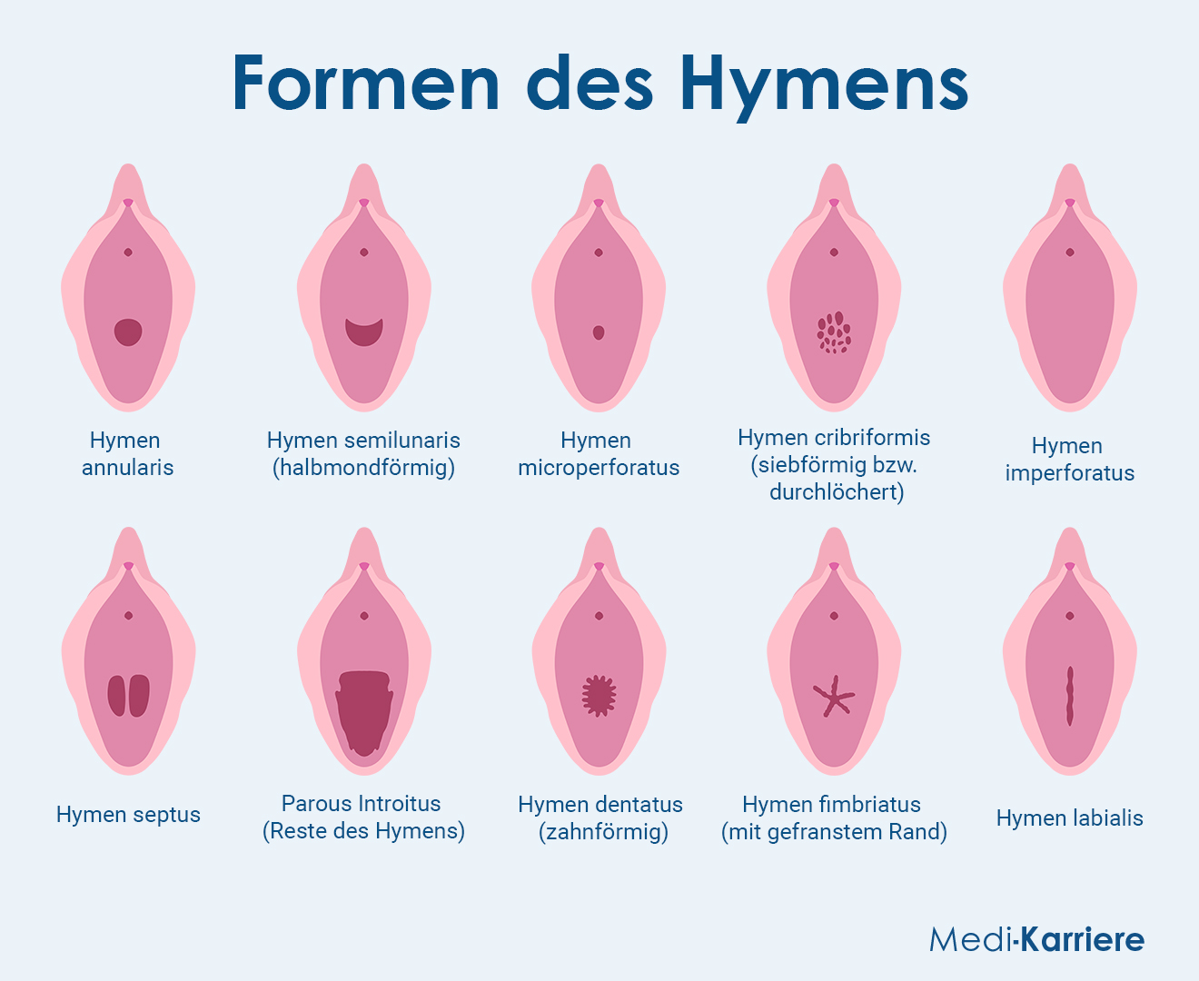 Jungfernhäutchen Grafik