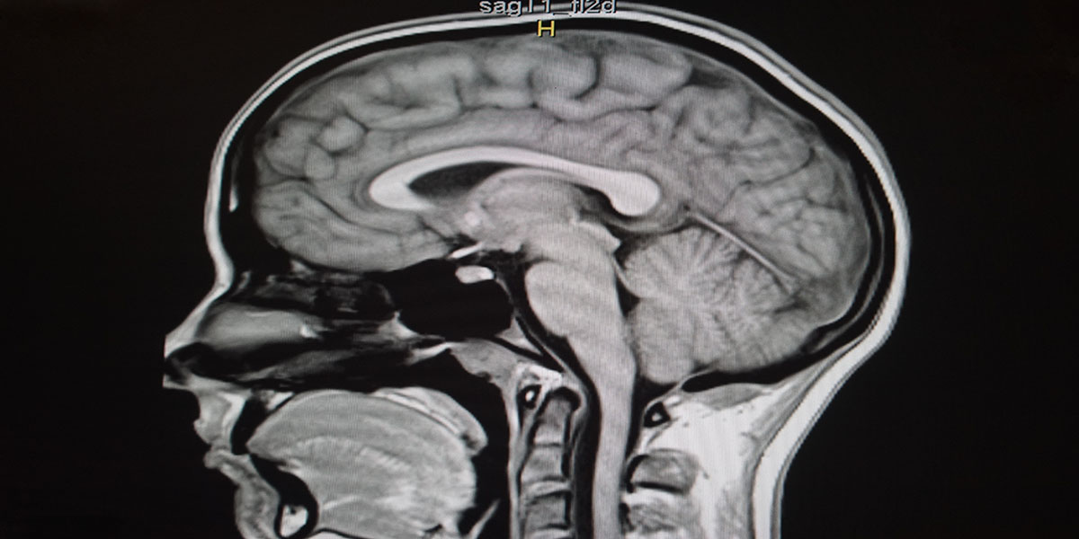 Sagittal,T1,Magnetic,Resonance,Image,Of,Brain