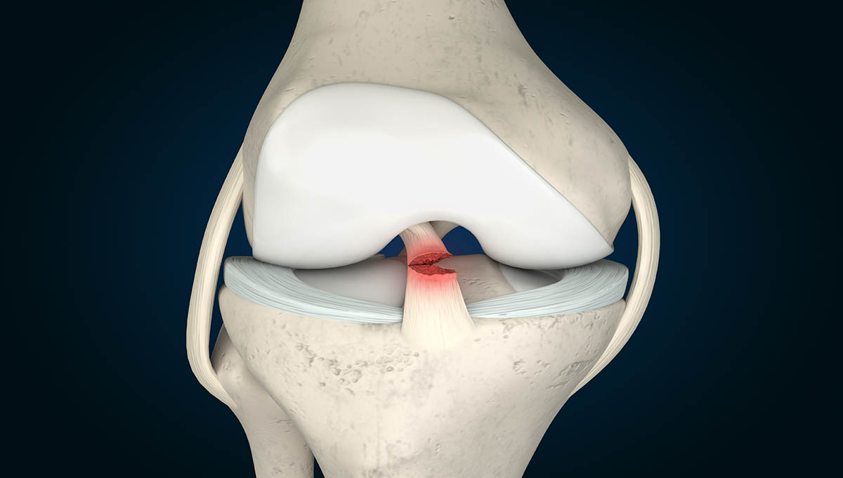 Anterior,Cruciate,Ligament,Tear,3d,Rendering,,Acl,Tear,,Acl,Injury,