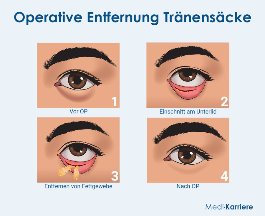 Grafik Tränensäcke