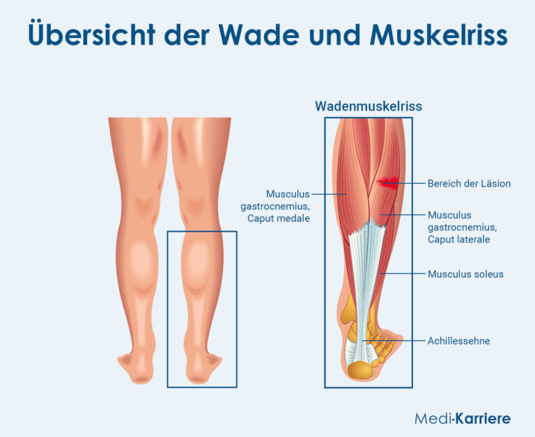 Musculus Gastrocnemius Verlauf Und Ruptur Des Wadenmuskels