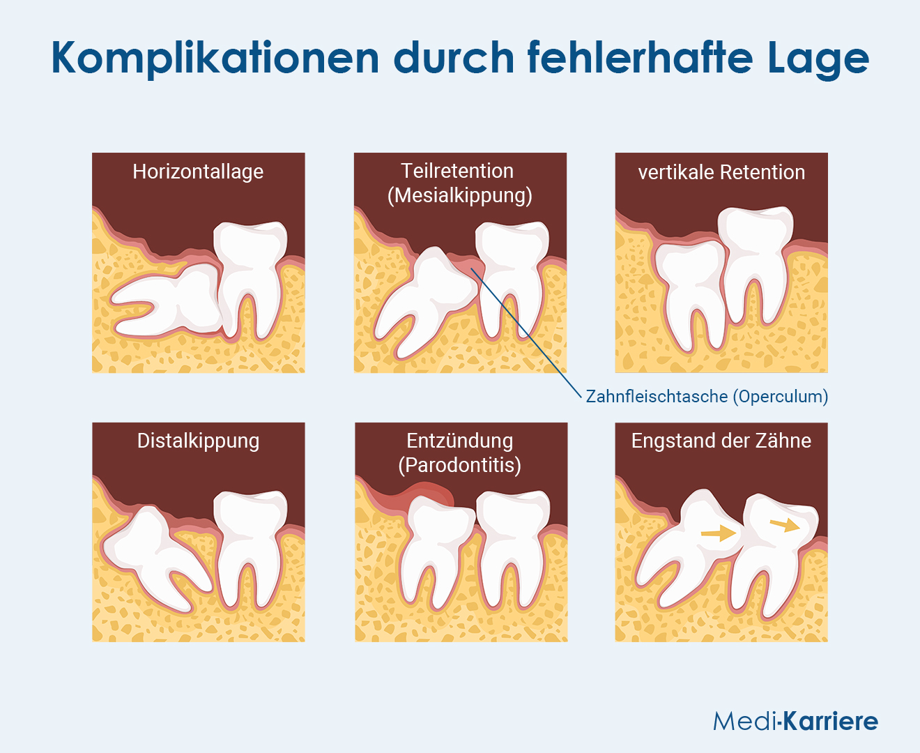 Weisheitszähne Grafik