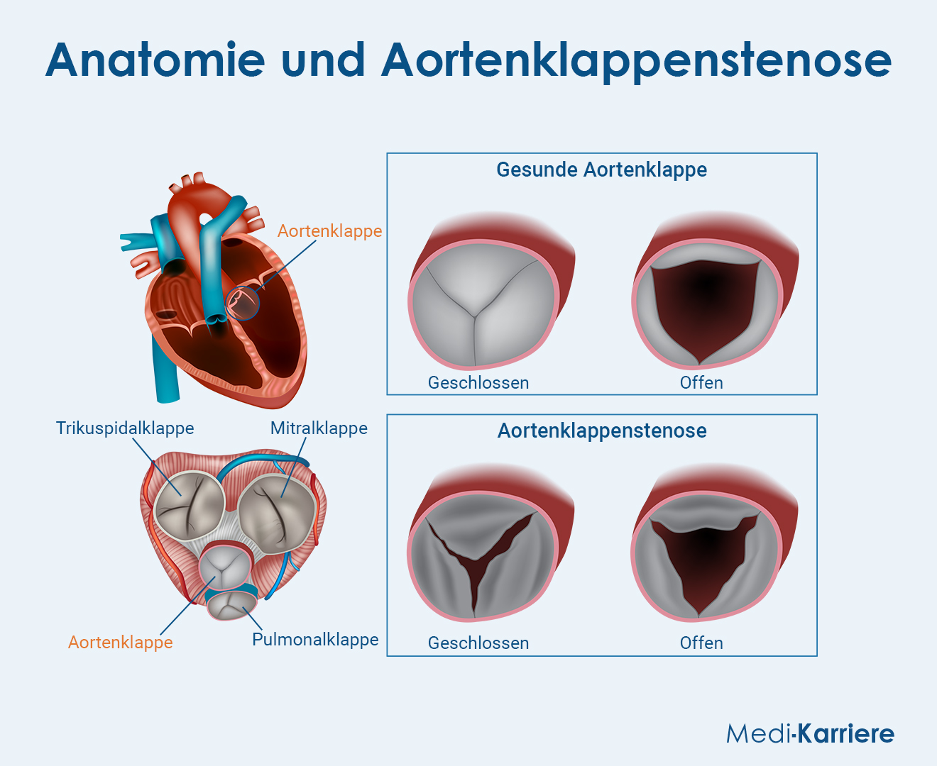 Aortenklappe Grafik