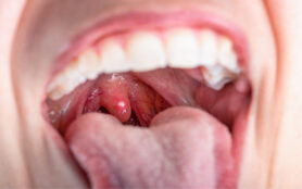 Close,Up,On,A,Canker,Sores.,Inflammation,Of,Oral,Cavity.