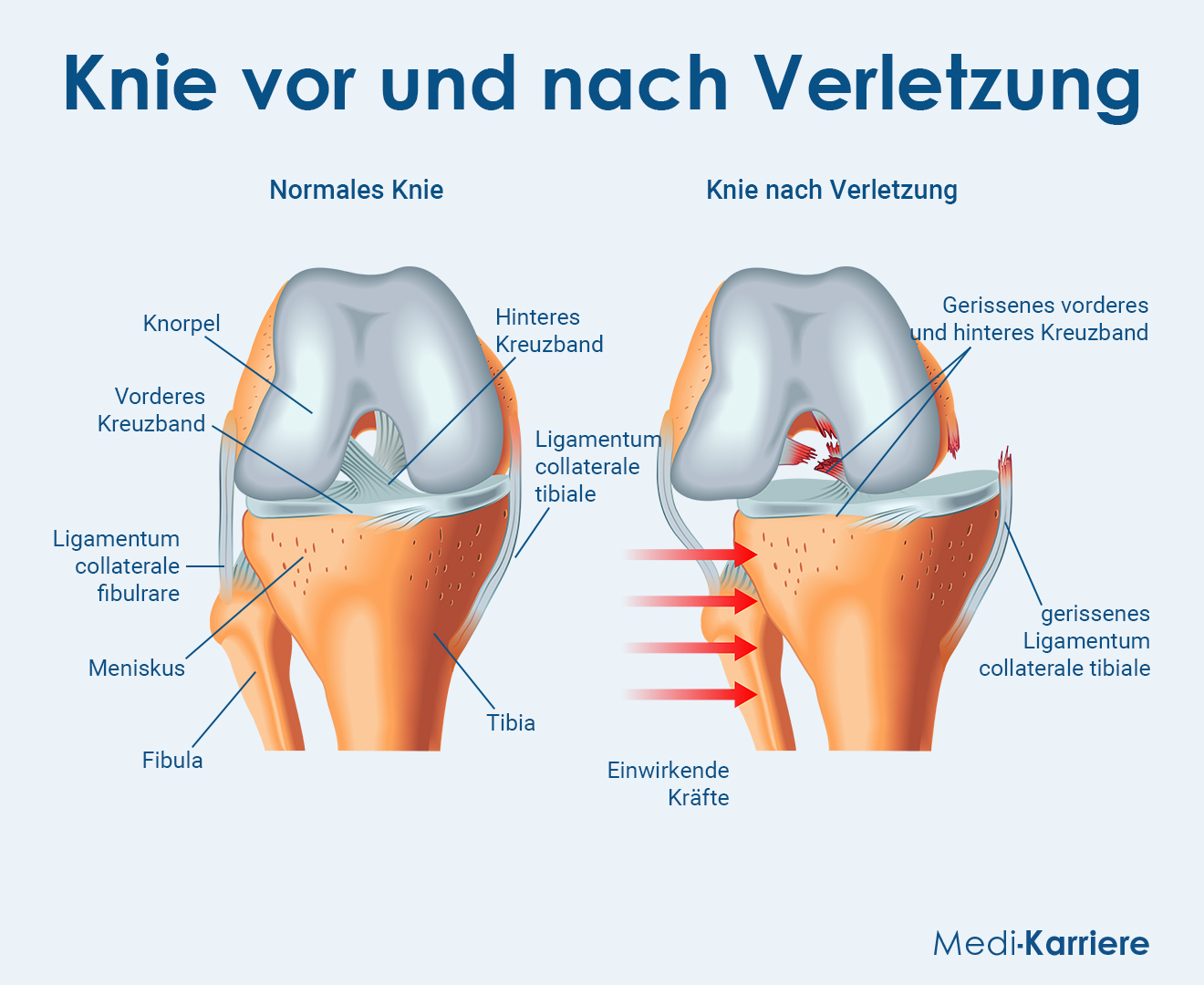 Kreuzband Grafik