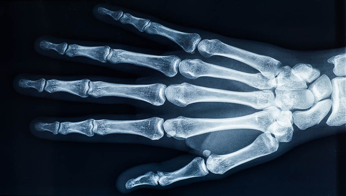 Human,Adult,Female,Right,Hand,Bones,X Ray,Image.,Medical,And