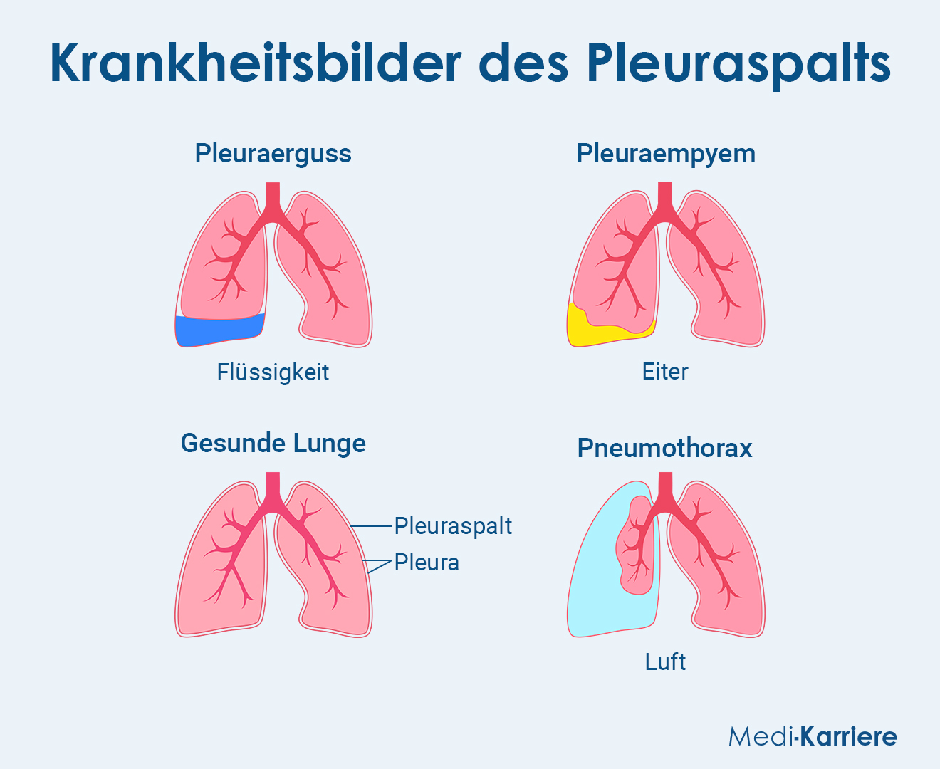 Pleuraspalt Grafik