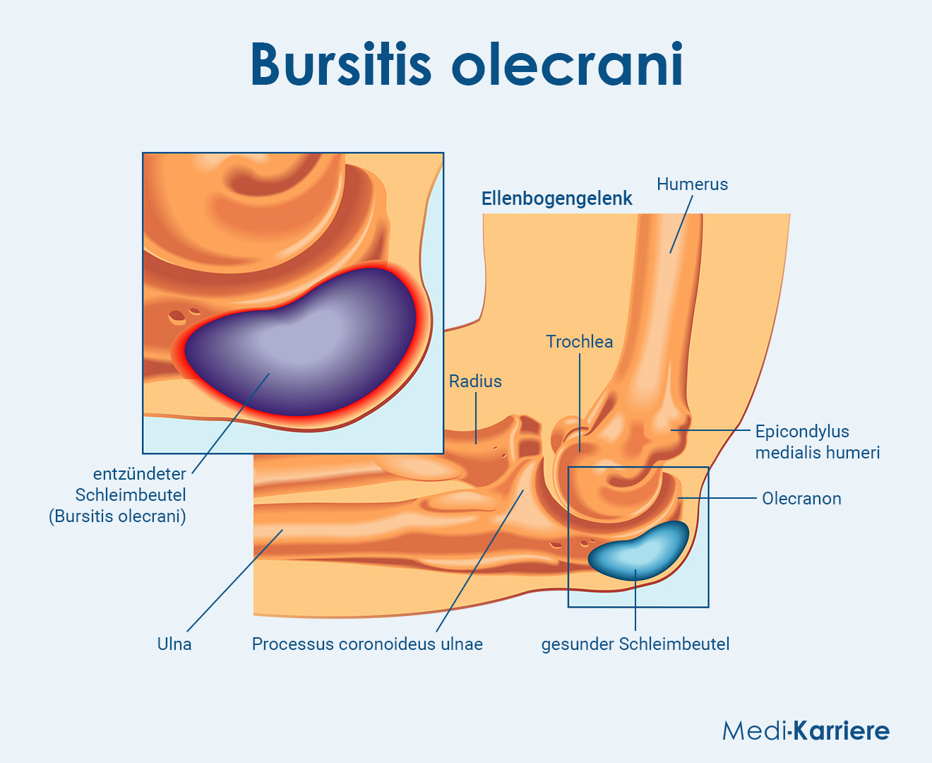 Schleimbeutel Ellenbogen Grafik