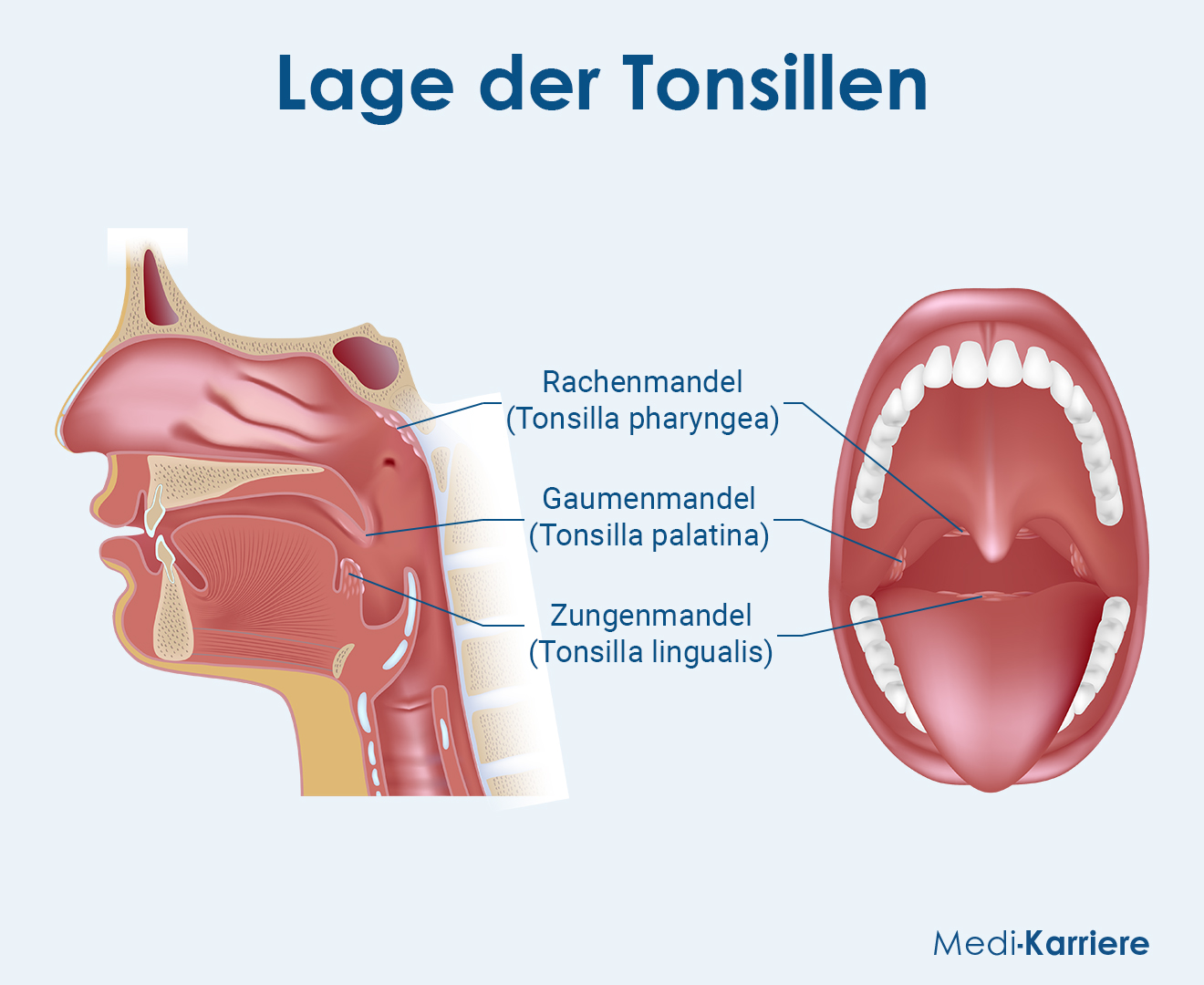 Tonsilien Grafik