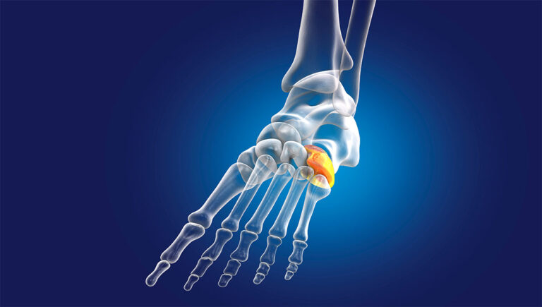 Würfelbein (Os cuboideum): Anatomie und Klinik