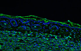 Tumour,Immunofluorescence,Ihc,Image.,Aggressive,Metastatic,Melanoma,Tumor,Cells,In