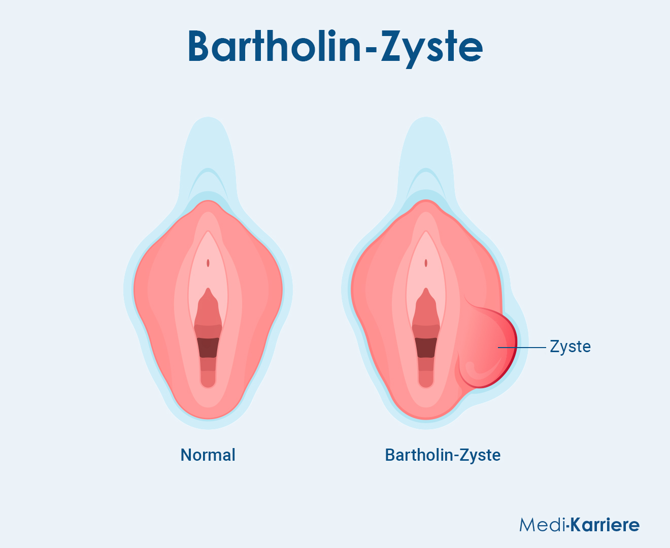 Bartholin Drüse Grafik