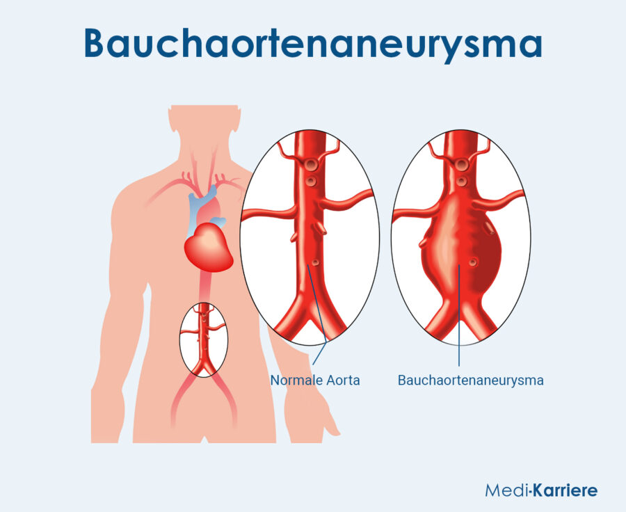 Grafik Bauchschlagader