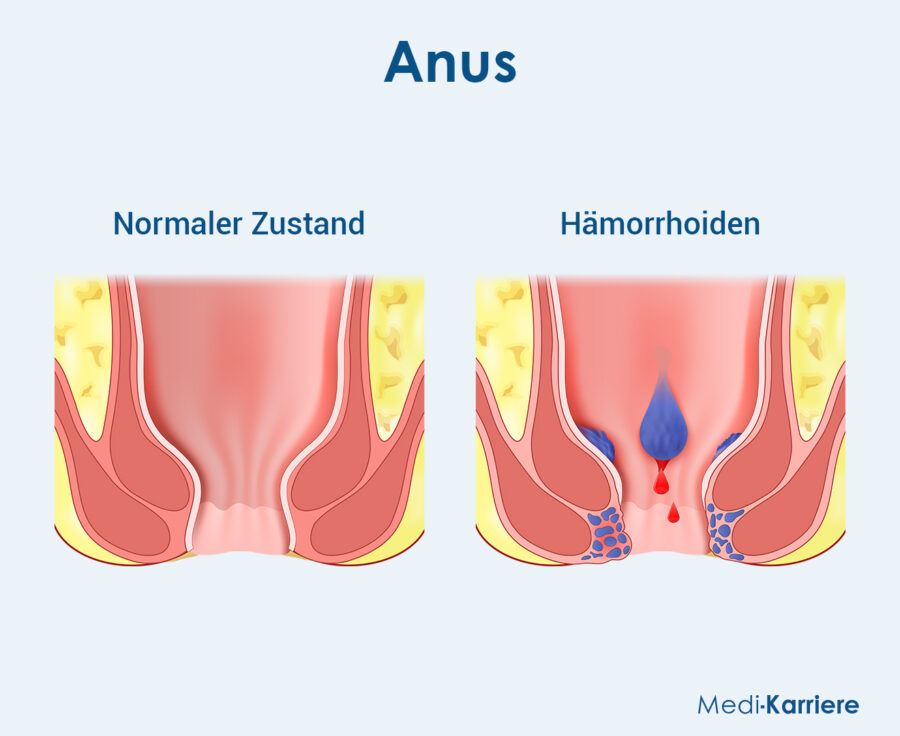 Anus Grafik