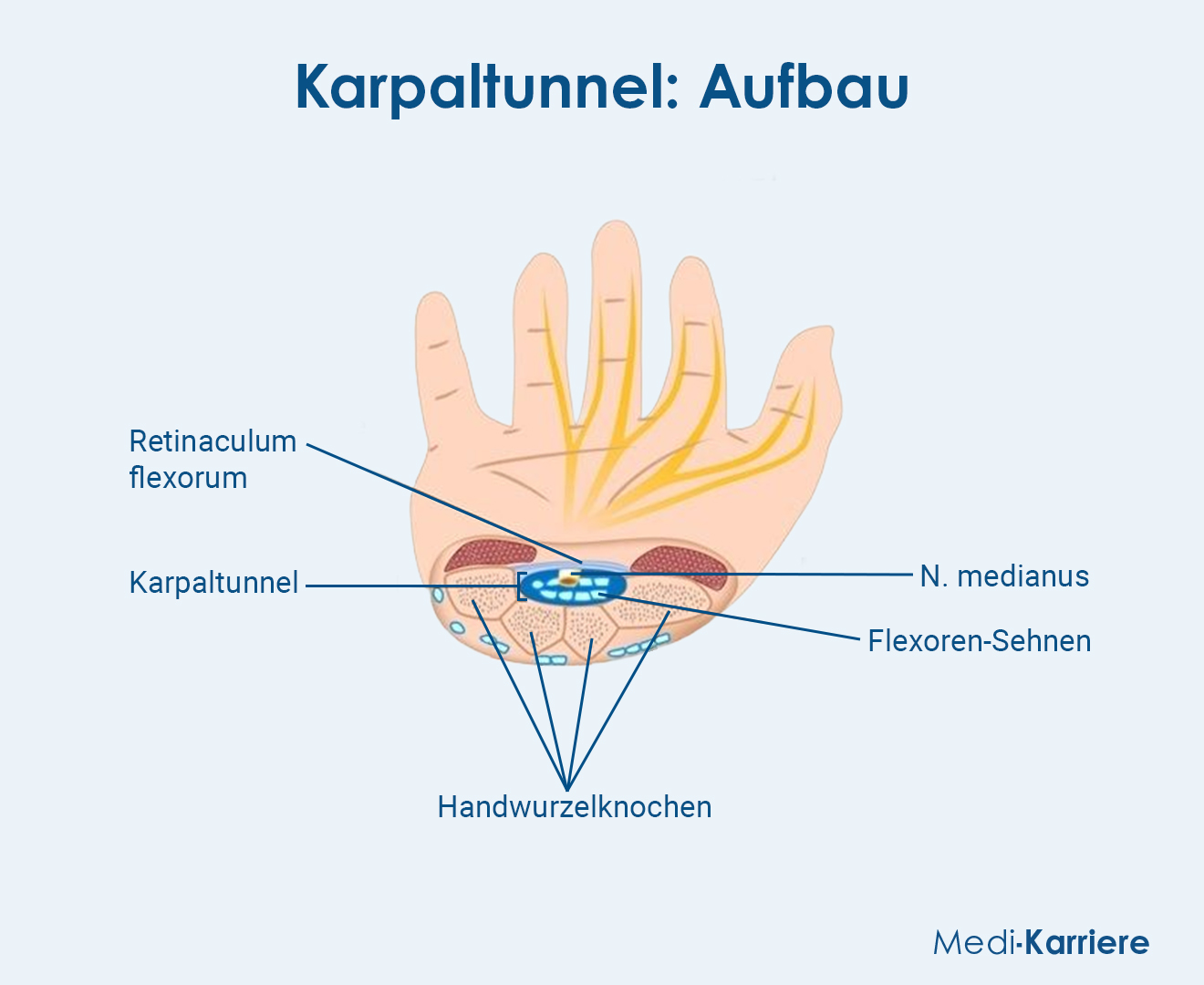 Karpaltunnel.Grafik