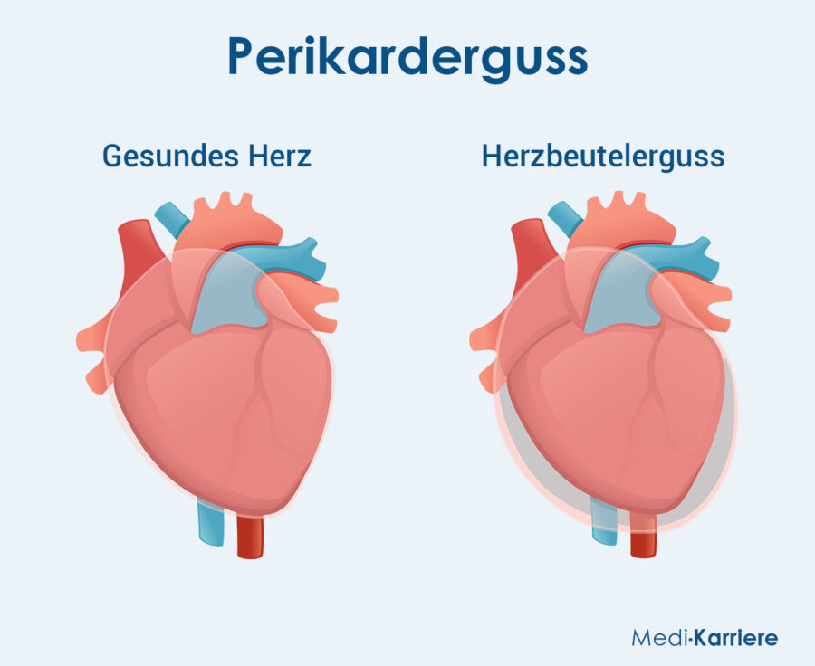 Perikard Grafik