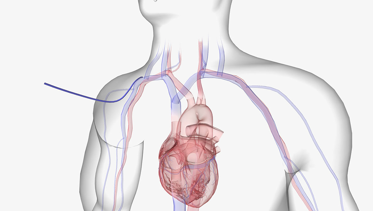 The,Subclavian,Vein,Is,One,Of,The,Most,Common,Sites