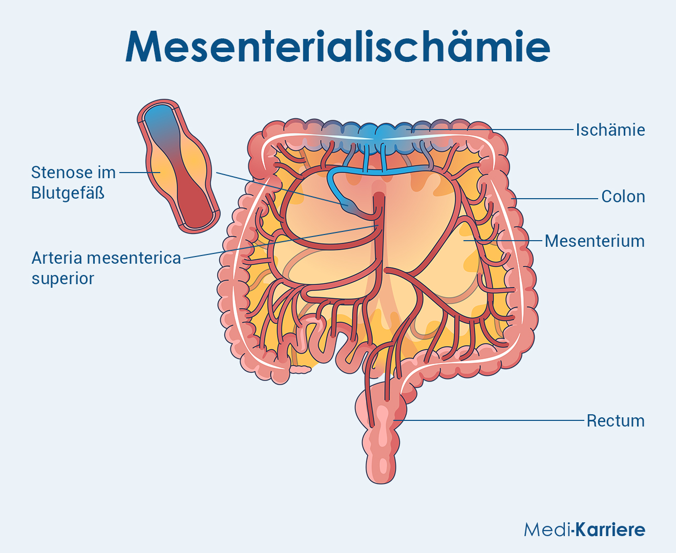 Arteria Mesenterica Superior 2 Grafik