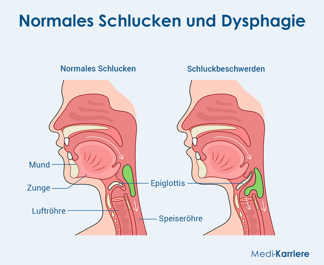 Epiglottis Grafik