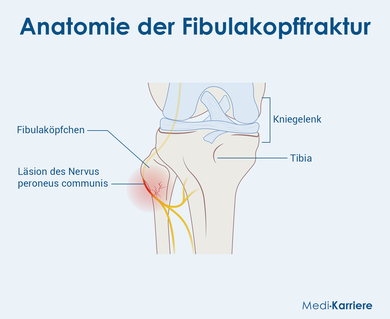 Fibulaköpfchen Grafik