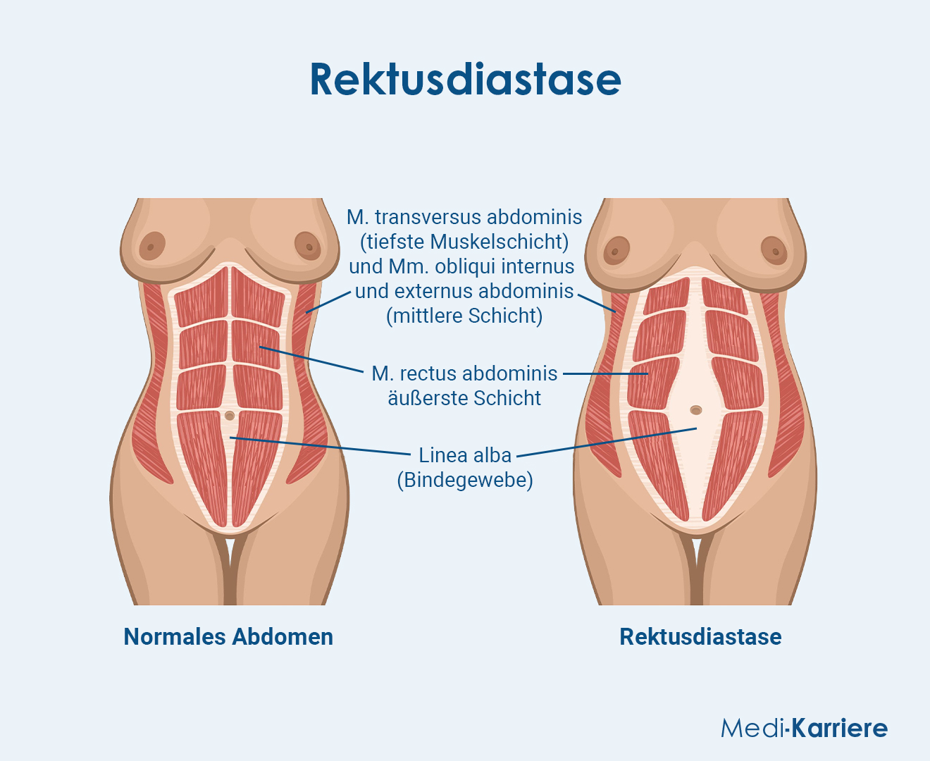 Bauchmuskulatur.Grafik