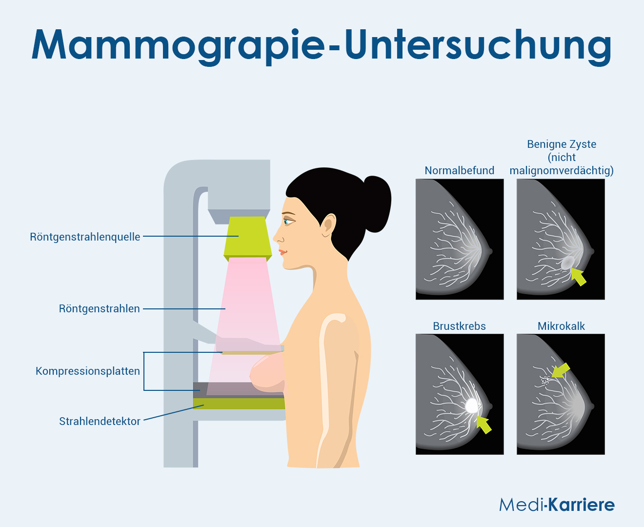 Mammographie Grafik