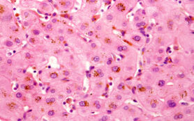 Human,Liver.,Cholestasis.,This,Micrograph,Shows,Brown,Deposits,Of,Bile